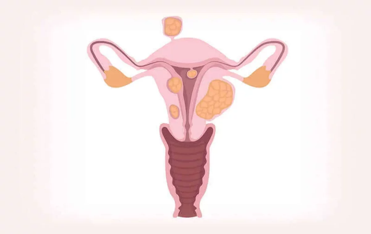 Miomas Uterinos